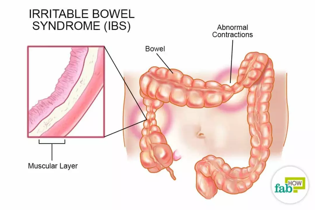 A Ligação entre Proctite e Síndrome do Intestino Irritável (SII)